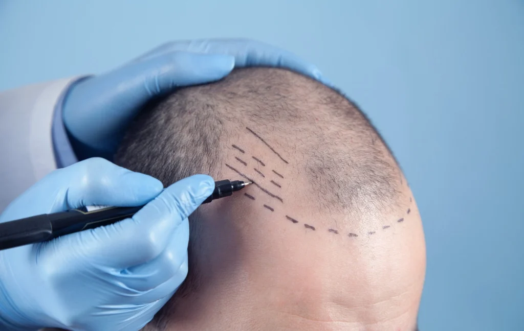 Hair Transplant Treatment